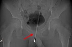 Adolescente precisa de cirurgia após inserir termômetro no pênis