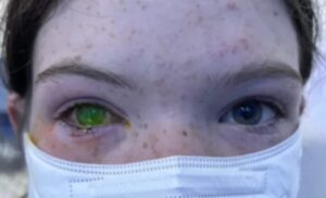 Doença que deixa olho esverdeado e ‘dói como parto’ deixa médicos em alerta