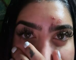MC Mirella é mordida por macaco de estimação na testa e é criticada na web