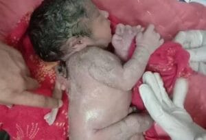 Extremamente raro: bebê nasce com três mãos na Índia