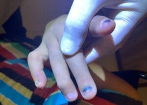 Cadeirante que teve unhas arrancadas pela própria irmã era torturada há 4 anos