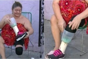 Após longa espera por equipamento, mulher cria prótese com liquidificador