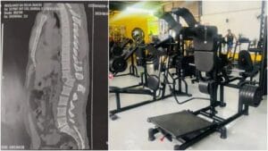 Tomografia mostra lesão considerada gravíssima na coluna de homem atingido por aparelho em academia