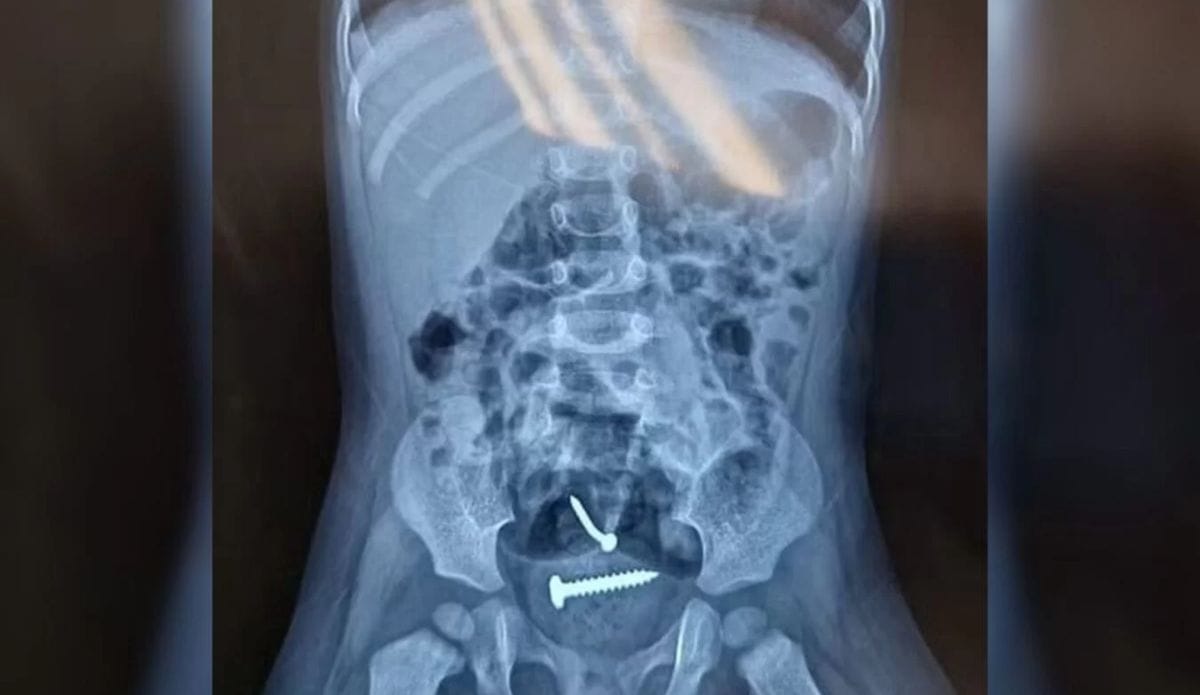 parafusos em criança de 1 ano