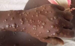 Mpox no Amazonas: 4 casos são confirmados e 9 suspeitos em novo boletim epidemiológico