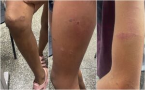 Violência em Manaus: jovem de 12 anos é queimada com sacolas