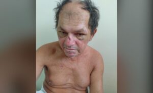 HPS João Lúcio busca familiares de paciente internado desde 10 de janeiro, vítima de atropelamento