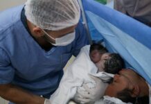 Caso raro: Maternidade Ana Braga realiza parto de gêmeas siamesas unidas pelo abdômen Parto raro de gêmeas siamesas é realizado com sucesso na rede pública de saúde do Amazonas Foto Arthur Castro Secom