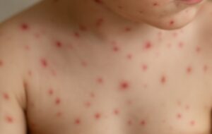 Após investigação, FVS descarta mpox em escolas de Iranduba e confirma casos de catapora