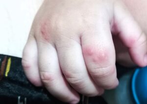 Mão-pé-boca: FVS reforça cuidados e mãe conta como descobriu a doença no filho