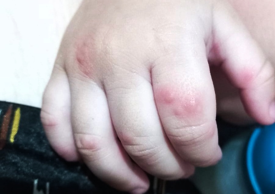 FVS RCP Mão Pé Boca FVS RCP Mão Pé Boca