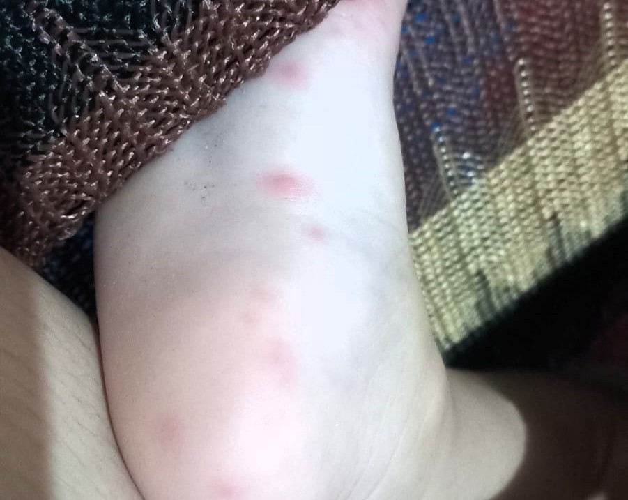 FVS RCP Mão Pé Boca FOTO Patrícia Queiroz Arquivo pessoal () () FVS RCP Mão Pé Boca FOTO Patrícia Queiroz Arquivo pessoal () ()