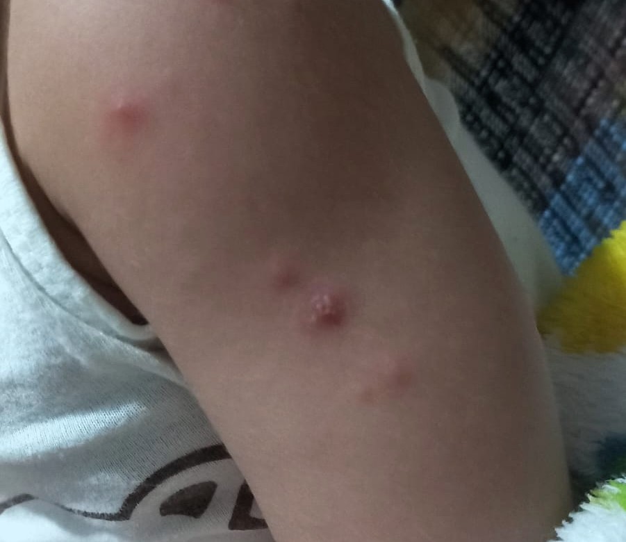 FVS RCP Mão Pé Boca FOTO Patrícia Queiroz Arquivo pessoal () () FVS RCP Mão Pé Boca FOTO Patrícia Queiroz Arquivo pessoal () ()