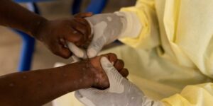 Brasil registra 88 casos de Mpox em 2026; São Paulo lidera com 62 infectados