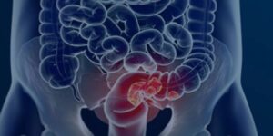 Rastreamento de câncer colorretal pode ser implementado no SUS, visando detecção precoce