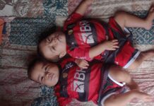 Gêmeas siamesas que nasceram na Maternidade Ana Braga completam 1 ano após caso de alta complexidade